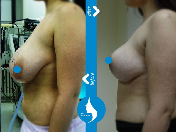 daskalov-breast-reduction-01-image600x450-crop