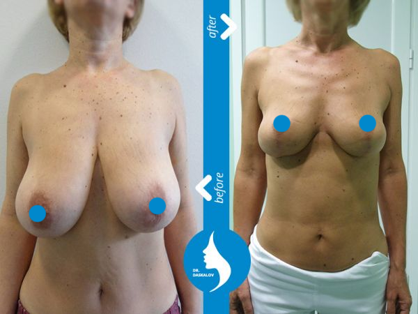 daskalov-breast-reduction-03-image600x450-crop