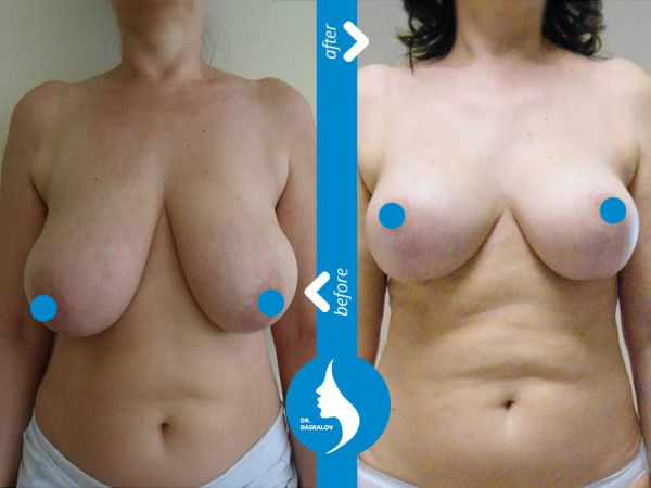 daskalov-breast-reduction-04-image600x450-crop