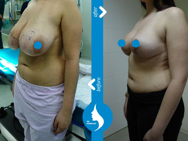 daskalov-breast-reduction-05c-image600x450-crop